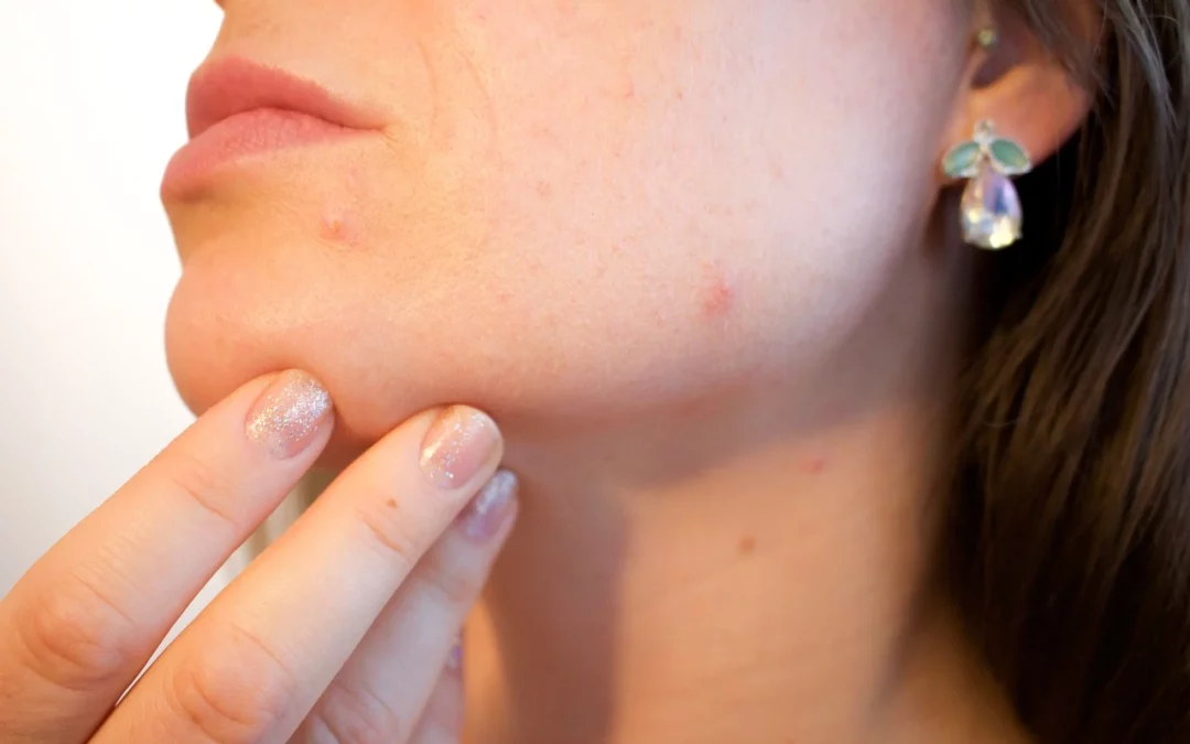 « Comprendre les Types de Peau: grasse, acnéique, mixte » »