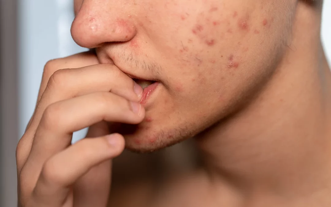 « Acné chez les Adolescents : Guide des Soins Esthétiques Purifiants en Institut »